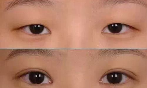 令人驚嘆！揭秘武漢華亞吳欣醫(yī)生的雙眼皮手術，身份資料披露！