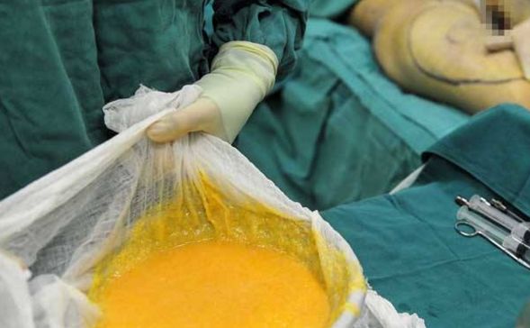 看準(zhǔn)這些?？漆t(yī)院，清楚雙眼皮手術(shù)，哪家最靠譜？