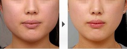 國內(nèi)治療兔唇的整形醫(yī)院排名大揭秘！這幾家醫(yī)院都在榜上