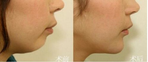 北京市前十名正頜醫(yī)院推薦：八處，協(xié)和，聯(lián)合麗格等，專業(yè)可靠！