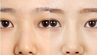 專業(yè)排行榜出爐！北京最頂級雙眼皮醫(yī)生名單公布！