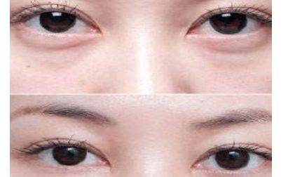 北京張笑天的下頜角手術(shù)技術(shù)及豐碩成果曝光！醫(yī)術(shù)精湛，案例展示震撼人心