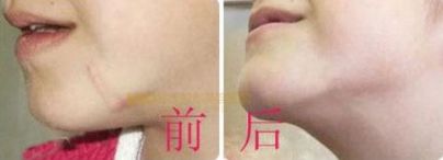 上海哪家醫(yī)院有專業(yè)的唇裂手術(shù)醫(yī)生？治療兔唇患者的必備信息！