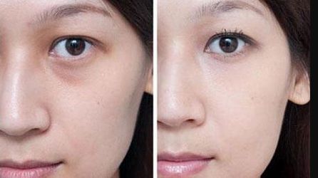 肉毒素除皺：您應(yīng)該意識(shí)到這些潛在風(fēng)險(xiǎn)