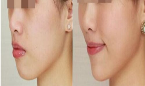 北京乳房整形首選之醫(yī)院：北京大學第三醫(yī)院值得推薦！