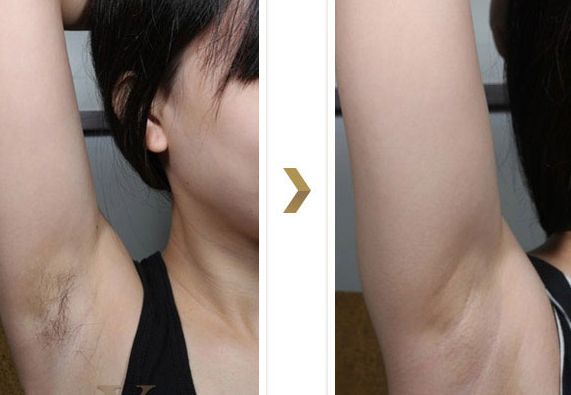 長(zhǎng)沙湘雅醫(yī)院的減肥科如何？大腿吸脂效果如何？