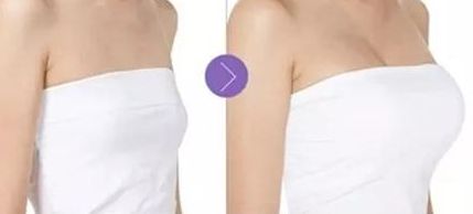 成都華美邱偉醫(yī)師分享隆鼻案例，鼻部塑造效果驚艷！