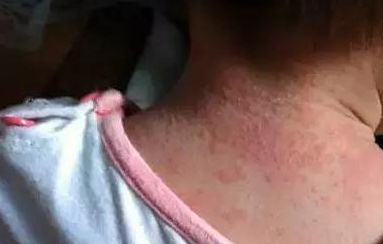 黃開亮眼睛美不美，醫(yī)生經(jīng)驗(yàn)公開！看雙眼皮整形成功案例