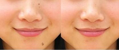 上海九院李茅醫(yī)生的雙眼皮手術(shù)效果如何？90天見證分享給你！