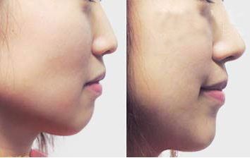 珠海采用新技術，瞬間消除黑眼圈的專業(yè)美容醫(yī)院預約