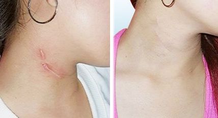 蘭州亞韓雙眼皮整形費(fèi)用一覽，談?wù)勈中g(shù)技巧與費(fèi)用