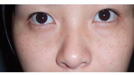 張恒術(shù)雙眼皮手術(shù)80天后效果揭曉，驚喜呈現(xiàn)！