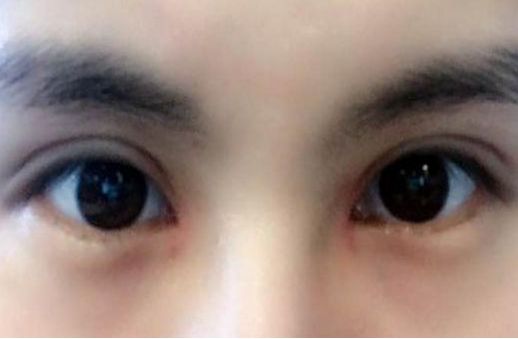 專家執(zhí)針絕活，您知道哪位醫(yī)生在注射物取出方面最厲害嗎？獨特手法排行榜前五名大揭曉