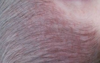 大慶彤銘醫(yī)學美容診所：體驗吸脂手術的醫(yī)生詳解與術后心得分享