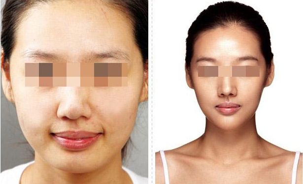 武漢恩娜整形中心：解讀雙眼皮手術(shù)全攻略，案例展示讓你真實了解效果！