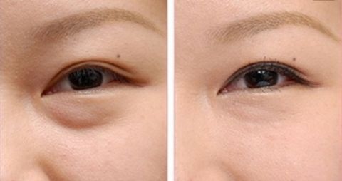 成都李烈療法注脂面部效果令人驚嘆！實例揭秘