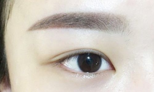 袁斯明醫(yī)生手術(shù)等待時間？術(shù)后恢復(fù)效果如何？眼部整容40天現(xiàn)圖曝光！