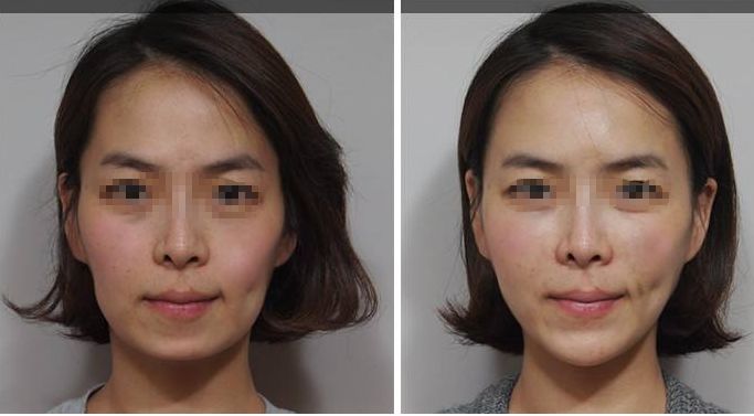 深圳頂級乳房整形專家團隊？權(quán)威醫(yī)院解答哪家三甲醫(yī)院最適合隆胸