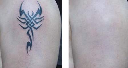 宋建星吸脂修復(fù)效果好嗎？吸脂修復(fù)宋建星技術(shù)如何？