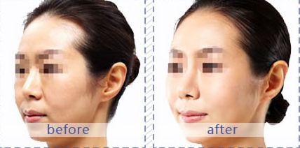 北京磨骨整形前十大醫(yī)院推薦：301、協(xié)和、聯(lián)合麗格、圣嘉新等