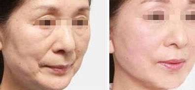 寧波頂級醫(yī)院去眼袋的價格及經(jīng)驗分享