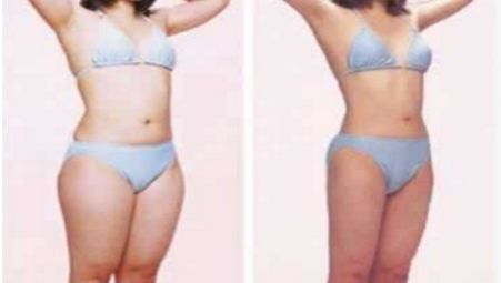 自體脂肪豐胸手術(shù)的副作用及不良反應(yīng)有何？