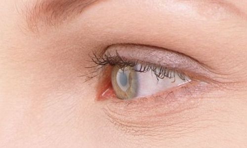 航空院眼袋手術(shù)效果如何？最新案例分享