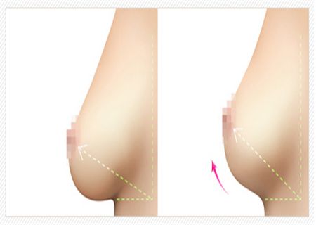 哈爾濱醫(yī)大一院乳房隆胸技藝揭秘！最新案例驚艷發(fā)布