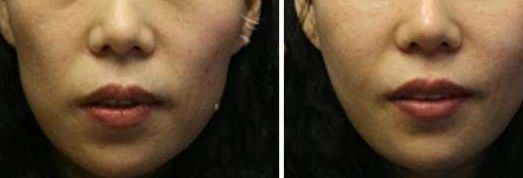 洛陽市第三人民醫(yī)院整形科雙眼皮效果如何？2023真實案例分享