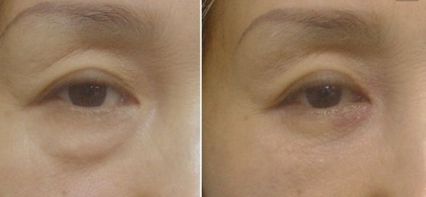 北京八大處趙延勇醫(yī)生的雙眼皮手術(shù)如何？了解醫(yī)院背景和手術(shù)案例。