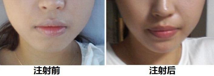 廣州豐胸手術(shù)那家靠譜？最新推薦！整形技術(shù)、價(jià)格醫(yī)生保駕護(hù)航