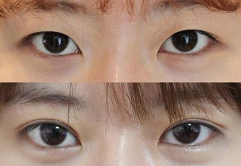 揭秘鐵嶺美嘉麗整形醫(yī)院引爆2023年吸脂療效