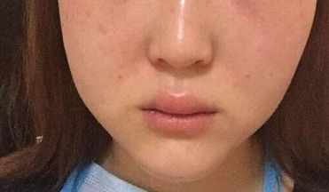 廣州美恩顧榮雙眼皮手術(shù)經(jīng)驗分享：90天親測案例展示