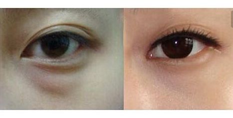 羅日云整容醫(yī)生的服務(wù)及費(fèi)用詳情，隱私公開！優(yōu)質(zhì)雙眼皮案例與收費(fèi)一覽供參考！