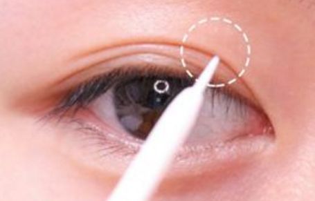 北京美聯(lián)臣路世敏醫(yī)生幫你告別歲月痕跡！除皺案例分享！