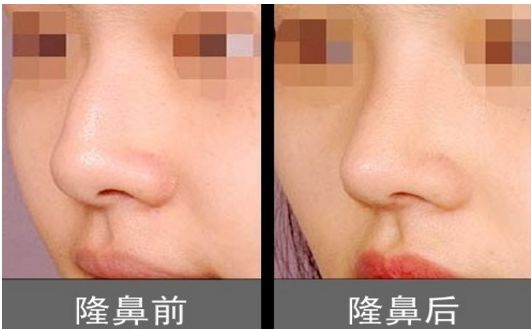 上海柴云醫(yī)生雙眼整形效果完美！手術(shù)前后真實(shí)照片呈現(xiàn)出專業(yè)水平