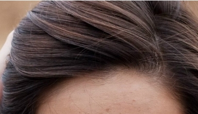 南昌二附院整形科眼袋抽脂效果好嗎？值得醫(yī)生推薦嗎？