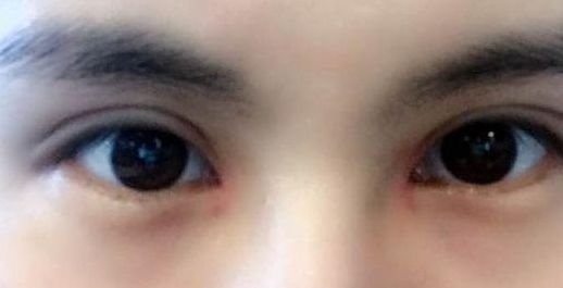 張盈帆雙眼皮手術(shù)費用評估！專家點評及最新報價公布！