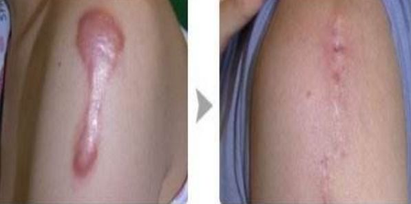 武漢仁愛時光醫(yī)療美容醫(yī)院優(yōu)質(zhì)案例分享，自體脂肪隆胸效果如何？