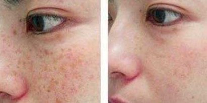 上海九院楊嫻嫻醫(yī)師專業(yè)雙眼皮整形介紹及成功案例分享