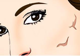 張曉建拉皮的效果好不好？如何評價？