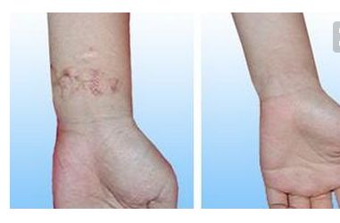 燕化醫(yī)院整形美容科：雙眼皮矯正價格及效果分享