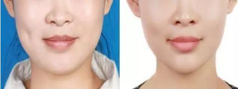 北京久經(jīng)考驗(yàn)的八大處雙眼皮醫(yī)生，蔣海越和馬繼光的美譽(yù)妙不可言