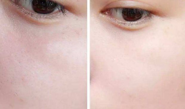 南京懿佳劉育鳳教您輕松擁有雙眼皮！專家妙手將為您呈現(xiàn)無(wú)數(shù)成功案例！