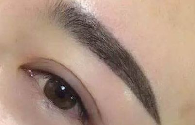 2023長沙愛思特張嬌嬌雙眼皮效果曝光！案例解析引發(fā)熱議