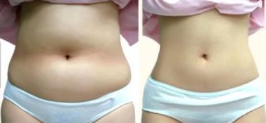 成都最佳面部吸脂醫(yī)生排名揭曉！八大靠譜醫(yī)生名單引爆話題！