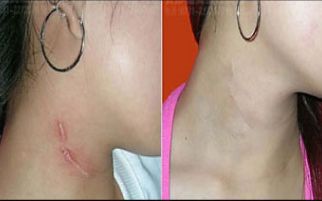 北京首都整形醫(yī)院雙眼皮修復(fù)效果如何？詳細(xì)案例揭秘