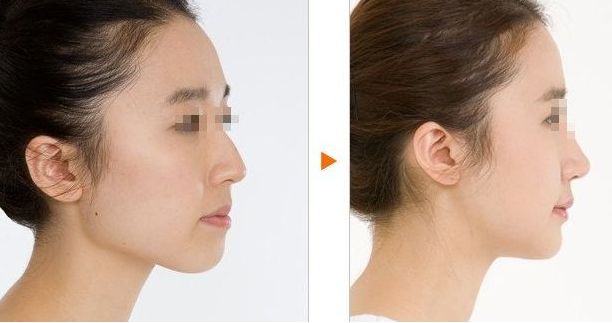 沈陽(yáng)隆胸整形哪家醫(yī)院技術(shù)領(lǐng)先？頭部醫(yī)療機(jī)構(gòu)推崇，專(zhuān)業(yè)醫(yī)生幫您圓夢(mèng)