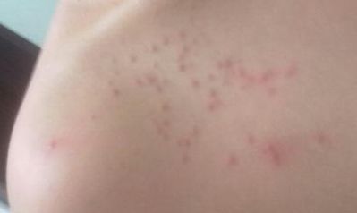 北京萬(wàn)達(dá)行姜洪濤醫(yī)生最新開(kāi)眼角效果分享！2023年價(jià)格公布！