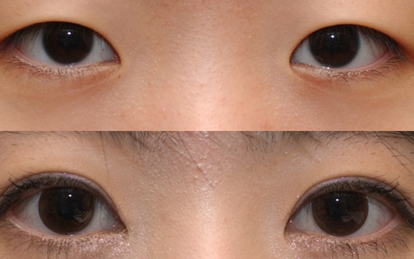 上海哪家醫(yī)院做眼袋手術(shù)價(jià)格實(shí)惠又靠譜？排行榜前十強(qiáng)！